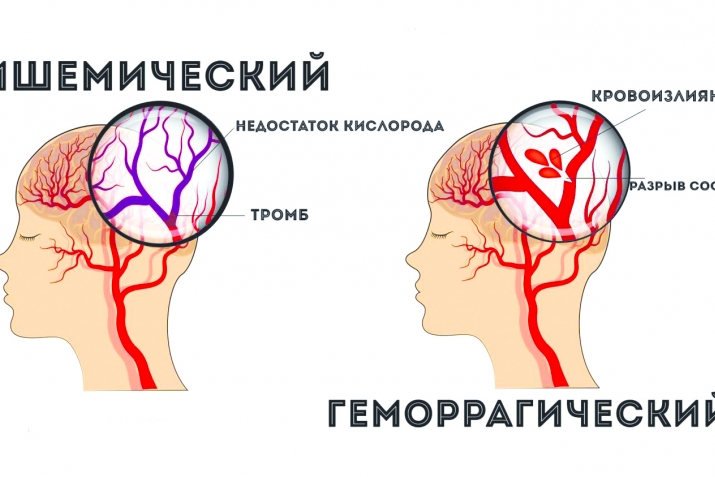 Инсульт. Сабпи дакьикьйирикан уьмур асиллу шула